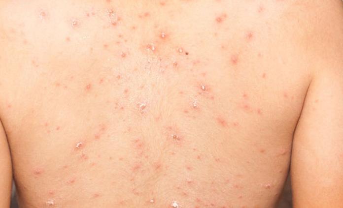 El actual brote de viruela de mono es «muy inusual» por la frecuencia de contagio: OMS