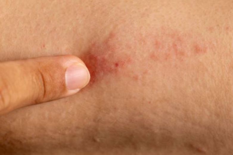 OMS planea contener viruela del mono minimizando transmisión humana