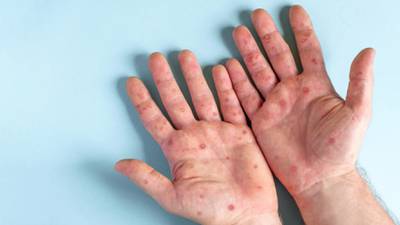 México acumula 147 casos de viruela del mono